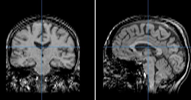 MRI for multiple sclerosis